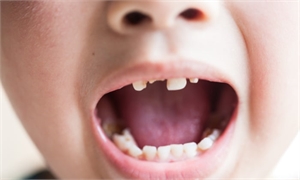 What Parents Need to Know About Rotten Baby Teeth