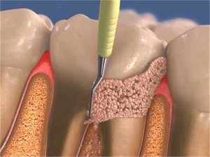 Subgingival curettage is scraping the dental tartar from the root surface below the gum margin