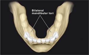 Bilateral mandibular tori (Torus Mandibularis on both sides of the mandible)