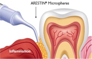 Arestin antimicrobial microspheres for periodontal treatment