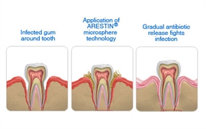 Arestin gum treatment