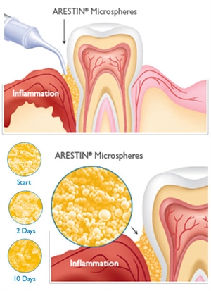 Arestin microspheres application in the gums