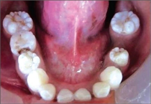 Mulberry molar teeth are a sign of congenital syphilis transmitted from the mother to the child