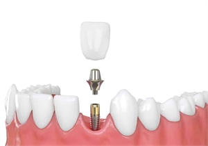 Reclaim Your Confidence: The Benefits of Dental Implants for Oral Health