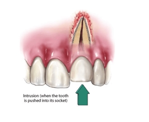 Tooth socket intrusion - dental intrusion