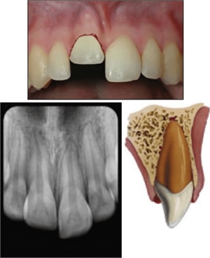 Dental intrusion is forceful invading the socket of the tooth by the tooth root