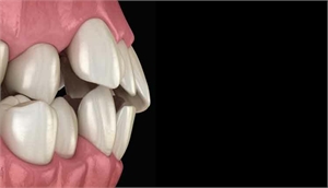 Occlusal trauma in dentistry