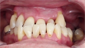 Patient suffering of occlusal trauma due to poor teeth alignment called malocclusion