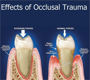 Effects of the occlusal trauma and excessive chewing forces on the periodontal condition of the teeth