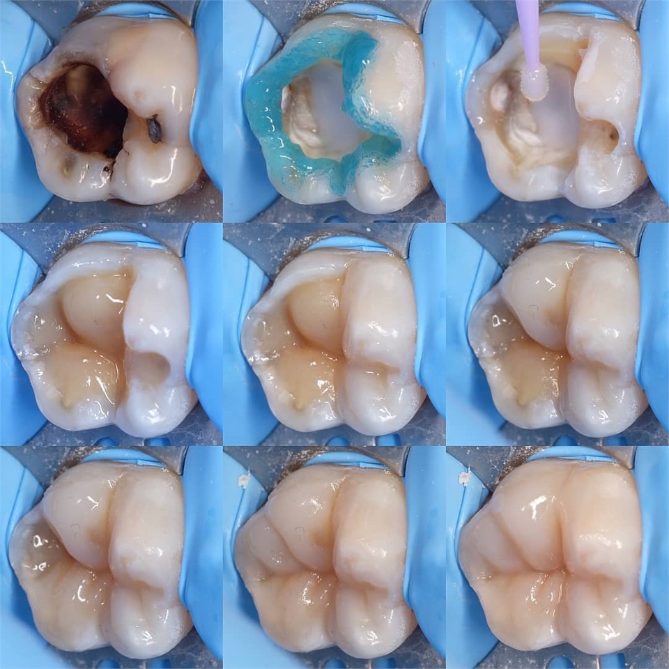 Restoring a tooth with a composite filling