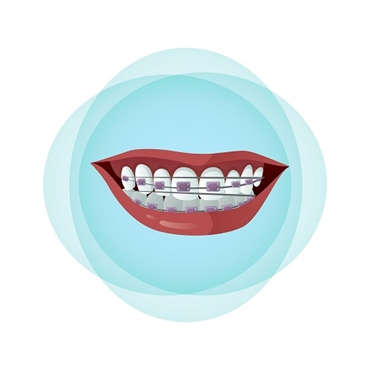 What Are the 5 Most Common Types of Braces Used in Orthodontic Treatment