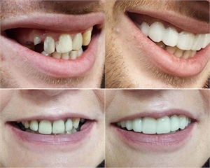 What are clip on veneers?