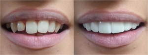 Removable dental veneers are a quick way to deliver a stunning white smile