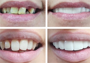 Clip on dental veneers can fill up the gaps left after teeth extractions and provide an instant white smile