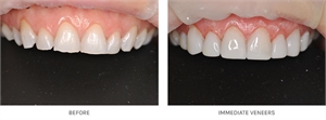 Instant veneers are also known as clip in teeth, snap on smile and removable dental veneers