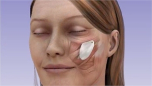 Cheek implants or Malar implants for cheekbone enhancement