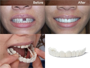 Snap-On Smile review
