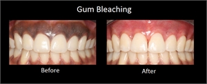 Gum bleaching