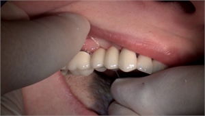 Patient flossing around ceramic dental bridge - the dental floss should go under the pontics to clean the debris between the bridge and alveolar ridge