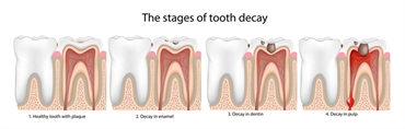 Tooth Decay Causes and Effects