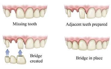 Everything You Wanted to Know about Dental Bridges