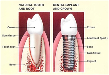 Dental Solutions for Missing Teeth