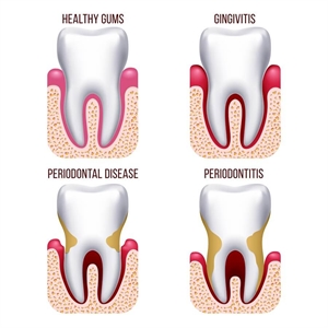 Gum Diseases: Differences between Gingivitis and Periodontitis