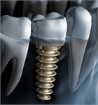 Dental Care and Implants Tijuana