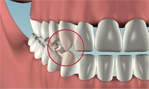 Canine guidance in dentistry is the path from central occlusion to edge-to-edge position created by the top and bottom canine teeth