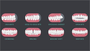Malocclusion types - crossbite, edge-to-edge bite, overjet, open bite, teeth crowding, spacing, midline shift, deep bite