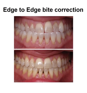 Edge-to-edge occlusion and bite correction with orthodontic treatment