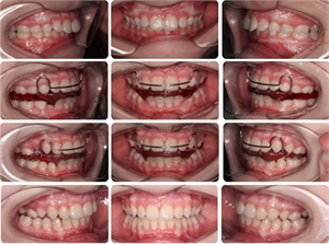 Treatment with orthodontic Bionator. How does the Bionator look like in the patient's mouth