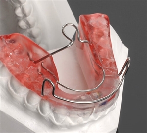 Bionator orthodontic appliance on a lab model