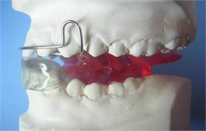 Bionator corrects underdeveloped mandible