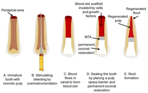 Regenerative endodontic procedures are based on removing the infected pulp and keeping the tooth alive by promoting a revascularization process.