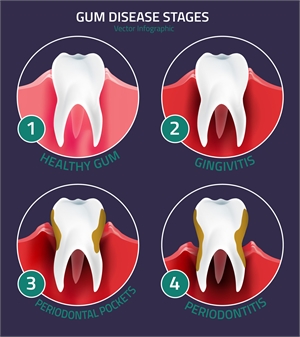 Gum disease stages