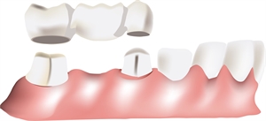 Dental bridge replacing a missing tooth.