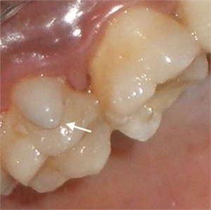 Cusp of Carabelli is an additional cusp located at the palatal surface of the first upper molar tooth