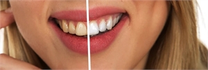 The Importance of Regular Teeth Checkups