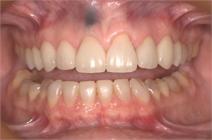The amalgam tattoo is caused by a previous apicoectomy of the upper right central incisor.