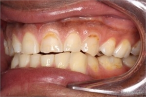Right-handed patient overbrushing the teeth on the left hand side. In this case the vigorous brushing has caused buccal enamel lesions and staining. 