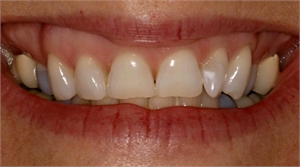 Right-handed patient overbrushing the teeth on the left hand side. In this case the overbrushing has caused gum recession on the left lateral incisor and canine.