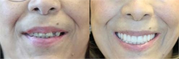 Before and After  Dental Implant