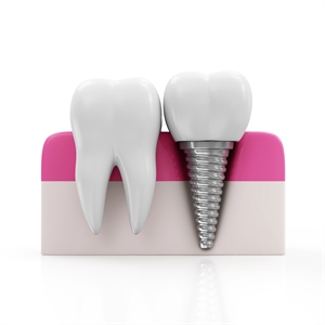 Tooth restoration with dental implants