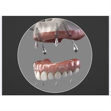 All-On-4 Dental Implants