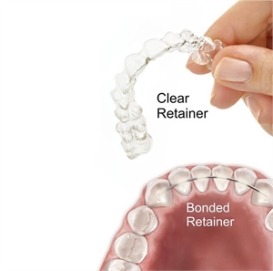 What is the difference between fixed retainer and removable retainer?