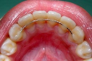 Bonded fixed retainer on the lingual surface of bottom anterior teeth