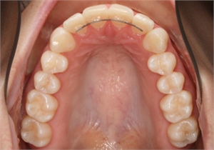 Fixed bonded retainer in the upper dental arch