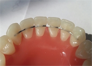 Fixed retainer on lower incisors