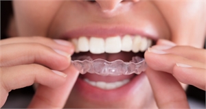 Removable retainer - invisible splint that fits on top of the upper teeth